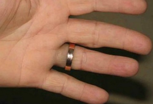 почему чернеет палец под обручальным кольцом
